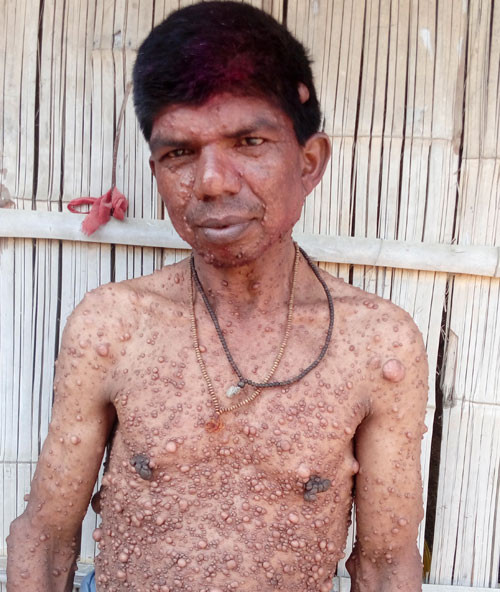 ३८ वर्षदेखि शरीरभरि मासुका डल्ला, उपचार कसले गर्ला