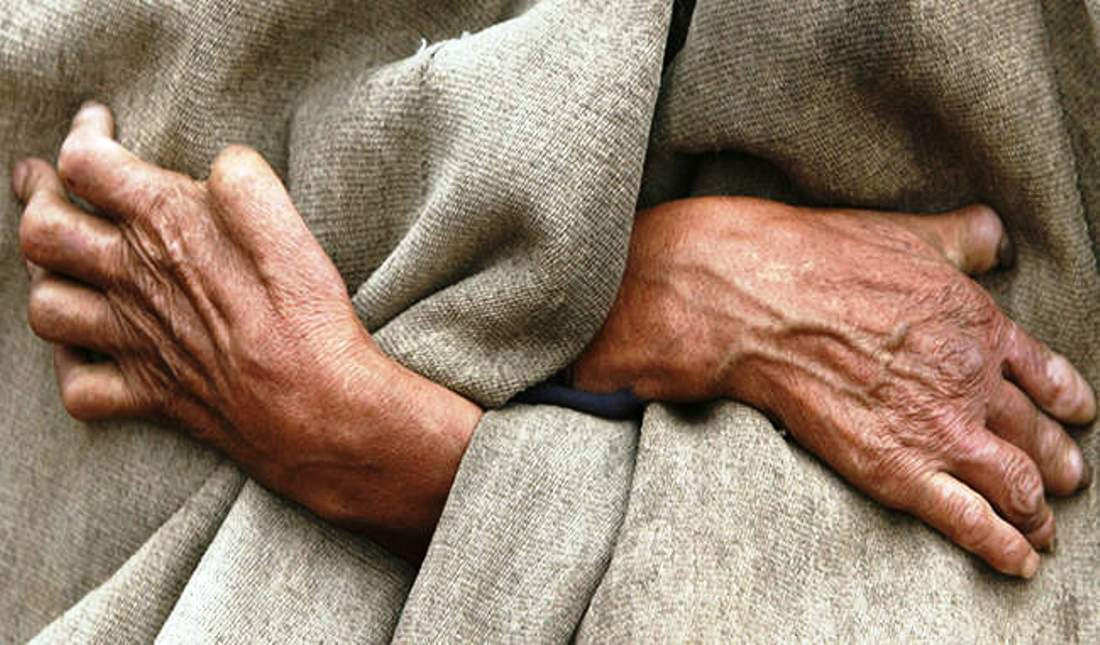 प्रदेश २ मा कुष्ठरोगका बिरामी सबैभन्दा बढी