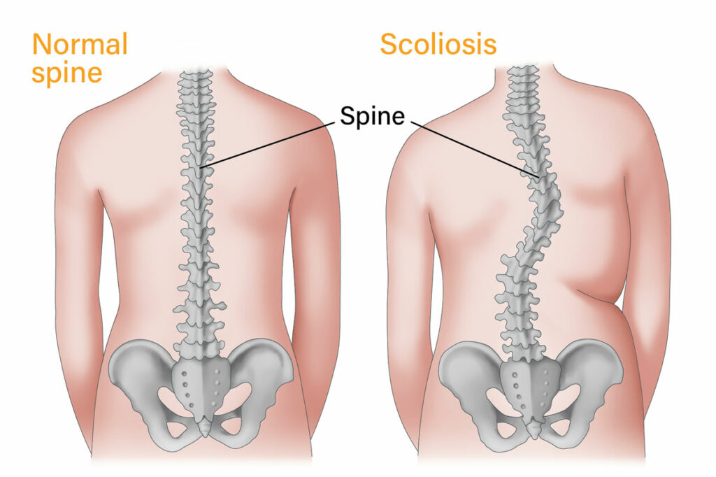 Scoliosis1687776927.jpg